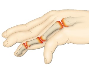 Rheumatische Erkrankungen